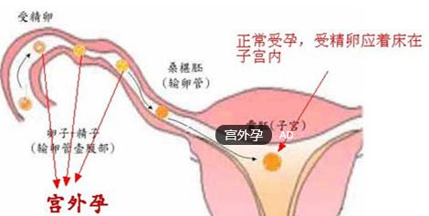 妇科人流|怀孕四个月可以无痛人流吗