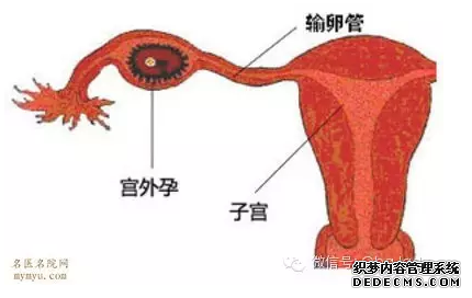 石河子妇科：宫外孕女性越来越多的“四大帮手”