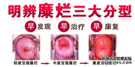 石河子二度宫颈糜烂